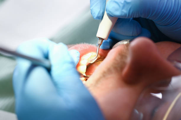 Best Knocked-Out Tooth (Avulsed Tooth) Treatment in Beverly Hills, TX